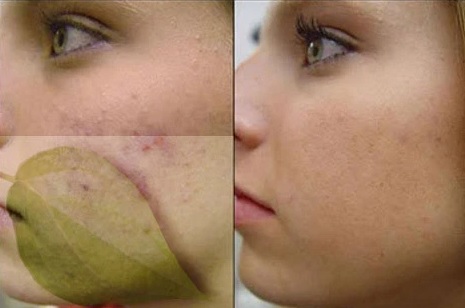 Perbedaan kulit wajah sebelum dan sesudah menggunakan daun sirih sebagai herabl penghilang jerawat.
